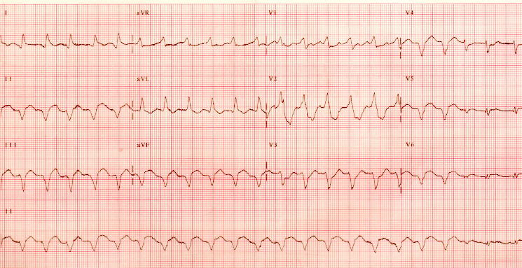 Al ver este ECG, ¿que debemos hacer en primer lugar?